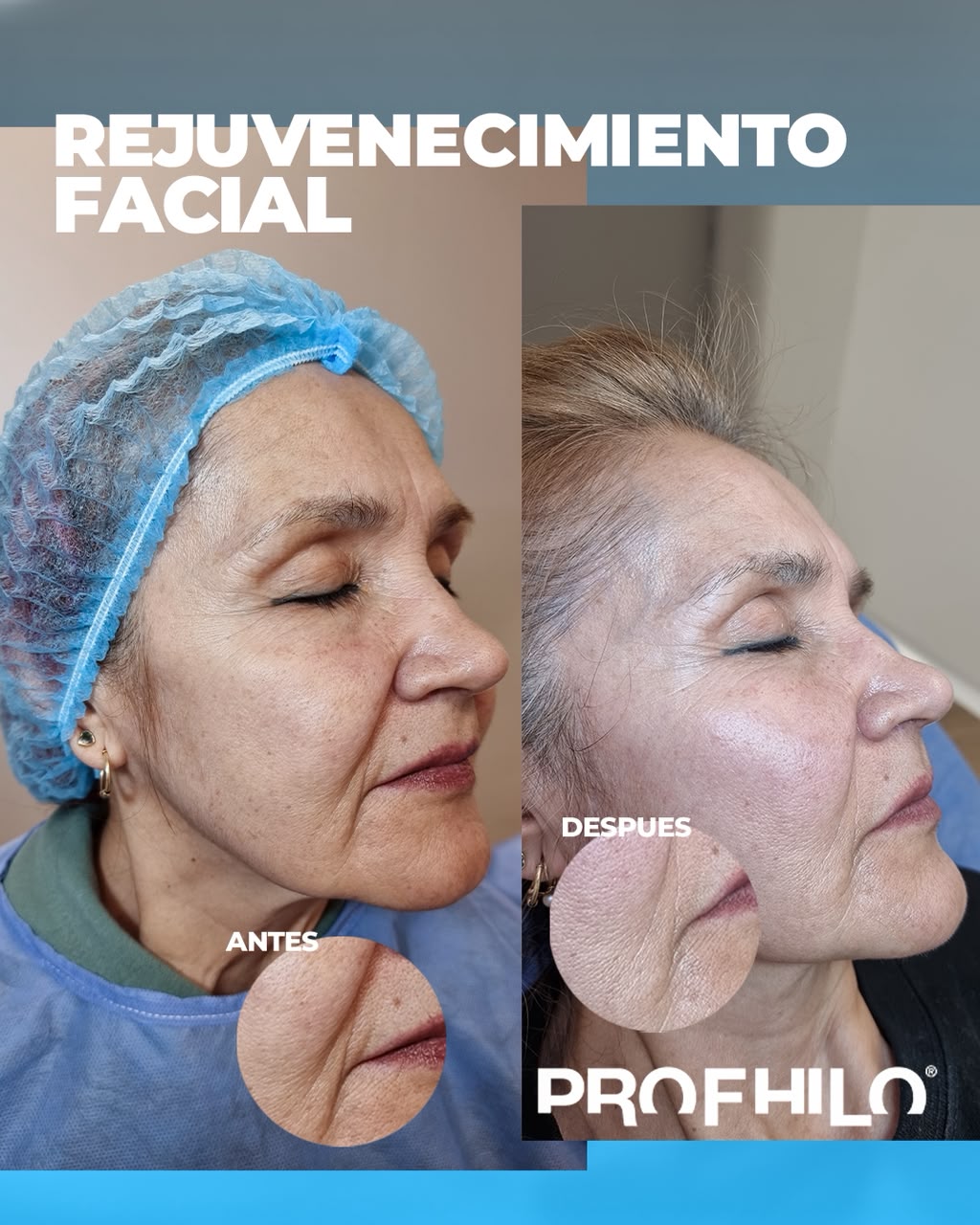 Antes y después de rejuvenecimiento facial con Profhilo