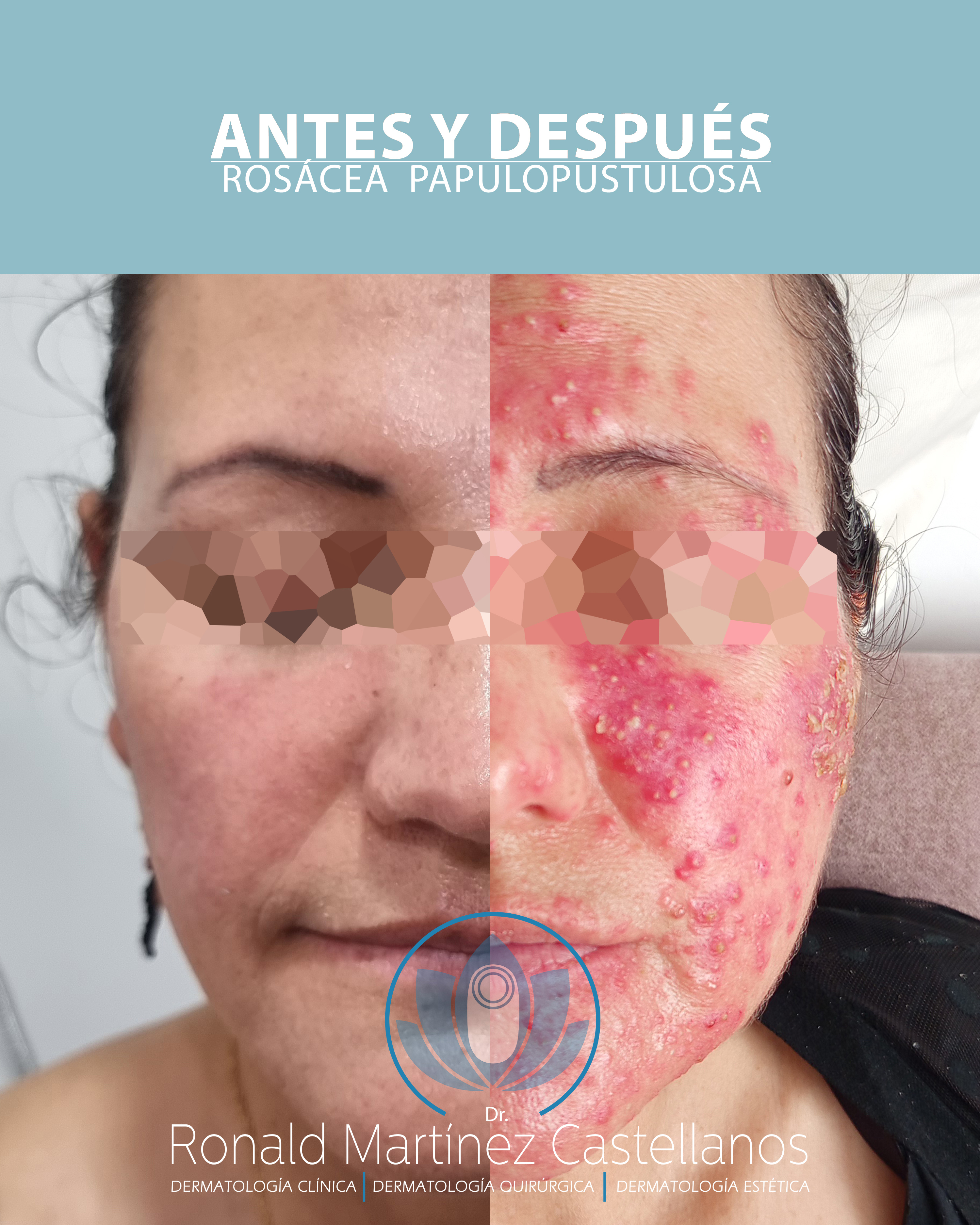 Antes y después de rosácea papulopustulosa